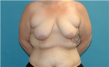 Breast Lift Before Photo by Scott Sattler, MD,  FACS; Seattle, WA - Case 50579