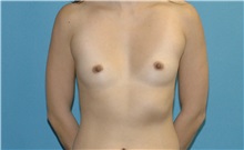 Breast Augmentation Before Photo by Scott Sattler, MD,  FACS; Seattle, WA - Case 50675