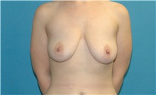 Breast Augmentation Before Photo by Scott Sattler, MD,  FACS; Seattle, WA - Case 50676