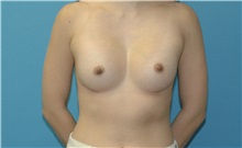 Breast Augmentation After Photo by Scott Sattler, MD,  FACS; Seattle, WA - Case 50678