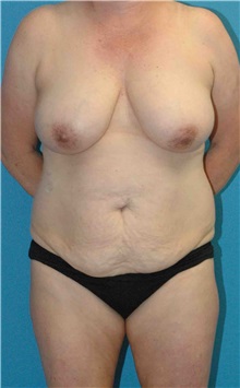 Mommy Makeover Before Photo by Scott Sattler, MD,  FACS; Seattle, WA - Case 50708