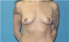 Breast Implant Removal After Photo by Scott Sattler, MD,  FACS; Seattle, WA - Case 50780