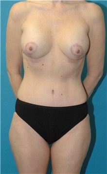 Mommy Makeover After Photo by Scott Sattler, MD,  FACS; Seattle, WA - Case 50793