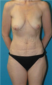 Mommy Makeover Before Photo by Scott Sattler, MD,  FACS; Seattle, WA - Case 50793