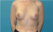 Breast Augmentation After Photo by Scott Sattler, MD,  FACS; Seattle, WA - Case 50794