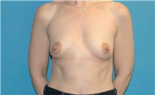 Breast Augmentation Before Photo by Scott Sattler, MD,  FACS; Seattle, WA - Case 50794