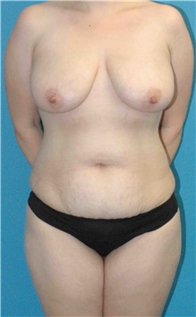 Mommy Makeover Before Photo by Scott Sattler, MD,  FACS; Seattle, WA - Case 50840