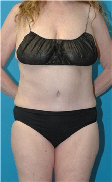 Tummy Tuck After Photo by Scott Sattler, MD,  FACS; Seattle, WA - Case 49997