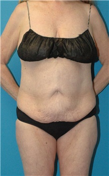Tummy Tuck Before Photo by Scott Sattler, MD,  FACS; Seattle, WA - Case 49997