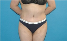 Tummy Tuck After Photo by Scott Sattler, MD, FACS; Seattle, WA - Case 50015 Tummy Tuck After Photo by Scott Sattler, MD, FACS; Seattle, WA - Case 50015