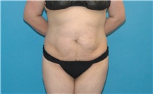 Tummy Tuck Before Photo by Scott Sattler, MD, FACS; Seattle, WA - Case 50015 Tummy Tuck Before Photo by Scott Sattler, MD, FACS; Seattle, WA - Case 50015