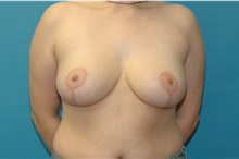 Breast Reduction After Photo by Scott Sattler, MD,  FACS; ,  - Case 50214