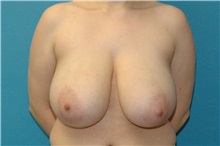 Breast Reduction Before Photo by Scott Sattler, MD,  FACS; ,  - Case 50214