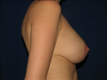 Breast Lift After Photo by Michael Milan, MD; Auburn Hills, MI - Case 23583