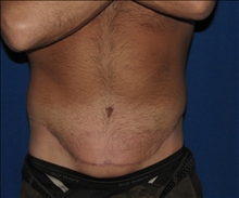 Body Contouring After Photo by Michael Milan, MD; Auburn Hills, MI - Case 23584