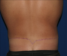 Body Contouring After Photo by Michael Milan, MD; Auburn Hills, MI - Case 23584