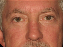 Eyelid Surgery After Photo by Michael Milan, MD; Auburn Hills, MI - Case 23585