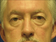 Eyelid Surgery Before Photo by Michael Milan, MD; Auburn Hills, MI - Case 23585