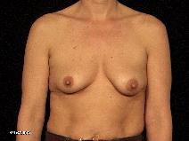 Breast Lift Before Photo by Michael Milan, MD; Auburn Hills, MI - Case 8293