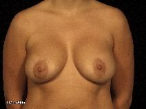 Breast Lift After Photo by Michael Milan, MD; Auburn Hills, MI - Case 8375