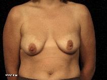 Breast Lift Before Photo by Michael Milan, MD; Auburn Hills, MI - Case 8375