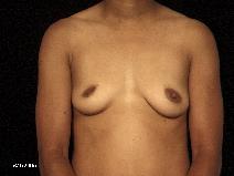Breast Augmentation Before Photo by Michael Milan, MD; Auburn Hills, MI - Case 8404