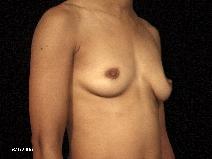 Breast Augmentation Before Photo by Michael Milan, MD; Auburn Hills, MI - Case 8404