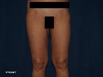 Liposuction After Photo by Michael Milan, MD; Auburn Hills, MI - Case 8523