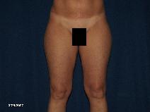 Liposuction Before Photo by Michael Milan, MD; Auburn Hills, MI - Case 8523