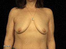 Breast Lift Before Photo by Michael Milan, MD; Auburn Hills, MI - Case 8601