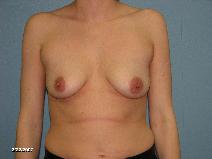 Breast Lift Before Photo by Michael Milan, MD; Auburn Hills, MI - Case 8603