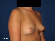 Breast Augmentation Before Photo by Michael Milan, MD; Auburn Hills, MI - Case 9066