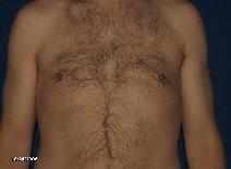 Male Breast Reduction After Photo by Michael Milan, MD; Auburn Hills, MI - Case 9084