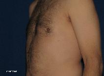 Male Breast Reduction After Photo by Michael Milan, MD; Auburn Hills, MI - Case 9085