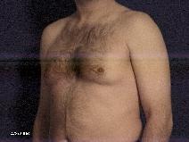 Male Breast Reduction Before Photo by Michael Milan, MD; Auburn Hills, MI - Case 9085