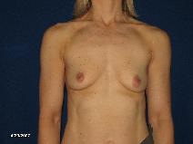 Breast Augmentation Before Photo by Michael Milan, MD; Auburn Hills, MI - Case 9350