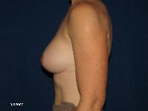 Breast Augmentation After Photo by Michael Milan, MD; Auburn Hills, MI - Case 9350