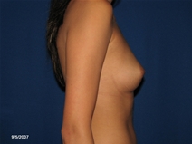 Breast Augmentation Before Photo by Michael Milan, MD; Auburn Hills, MI - Case 9487