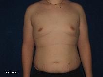 Male Breast Reduction After Photo by Michael Milan, MD; Auburn Hills, MI - Case 9678
