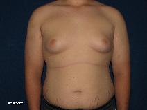 Male Breast Reduction Before Photo by Michael Milan, MD; Auburn Hills, MI - Case 9678