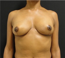 Breast Reduction After Photo by Dzifa Kpodzo, MD; Albany, GA - Case 33002