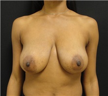 Breast Reduction Before Photo by Dzifa Kpodzo, MD; Albany, GA - Case 33002