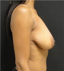 Breast Reduction Before Photo by Dzifa Kpodzo, MD; Albany, GA - Case 33002