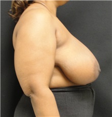 Breast Reduction Before Photo by Dzifa Kpodzo, MD; Albany, GA - Case 33005