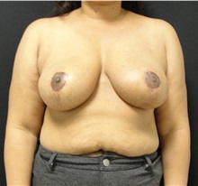 Breast Reduction After Photo by Dzifa Kpodzo, MD; Albany, GA - Case 33006