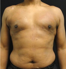 Male Breast Reduction After Photo by Dzifa Kpodzo, MD; Albany, GA - Case 33007