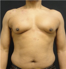 Male Breast Reduction Before Photo by Dzifa Kpodzo, MD; Albany, GA - Case 33007