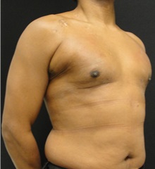Male Breast Reduction After Photo by Dzifa Kpodzo, MD; Albany, GA - Case 33007