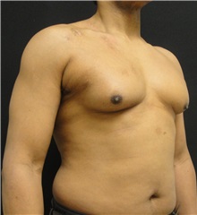 Male Breast Reduction Before Photo by Dzifa Kpodzo, MD; Albany, GA - Case 33007