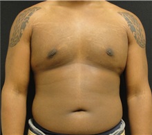 Male Breast Reduction After Photo by Dzifa Kpodzo, MD; Albany, GA - Case 33008